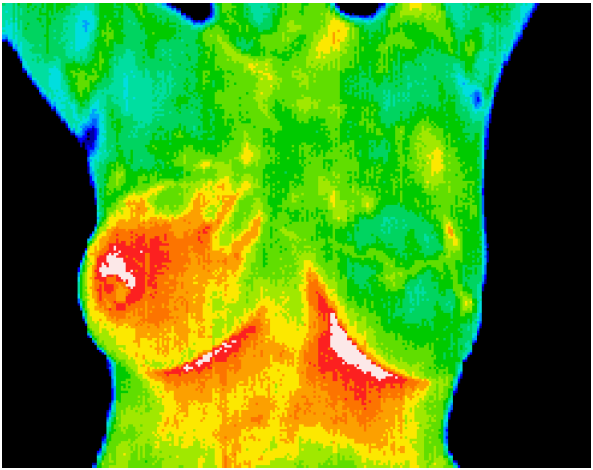 Inflamed Breast